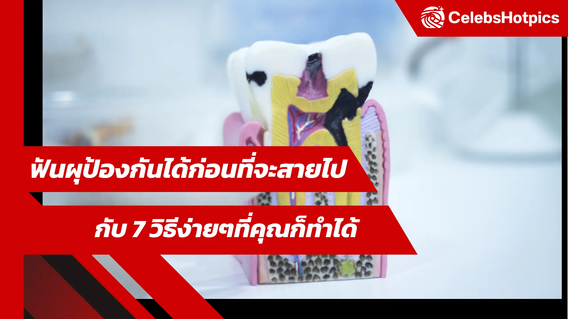 ฟันผุป้องกันได้ก่อนที่จะสายไป กับ 7 วิธีง่ายๆที่คุณก็ทำได้